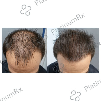 Tinfal Plus Solution 60ml